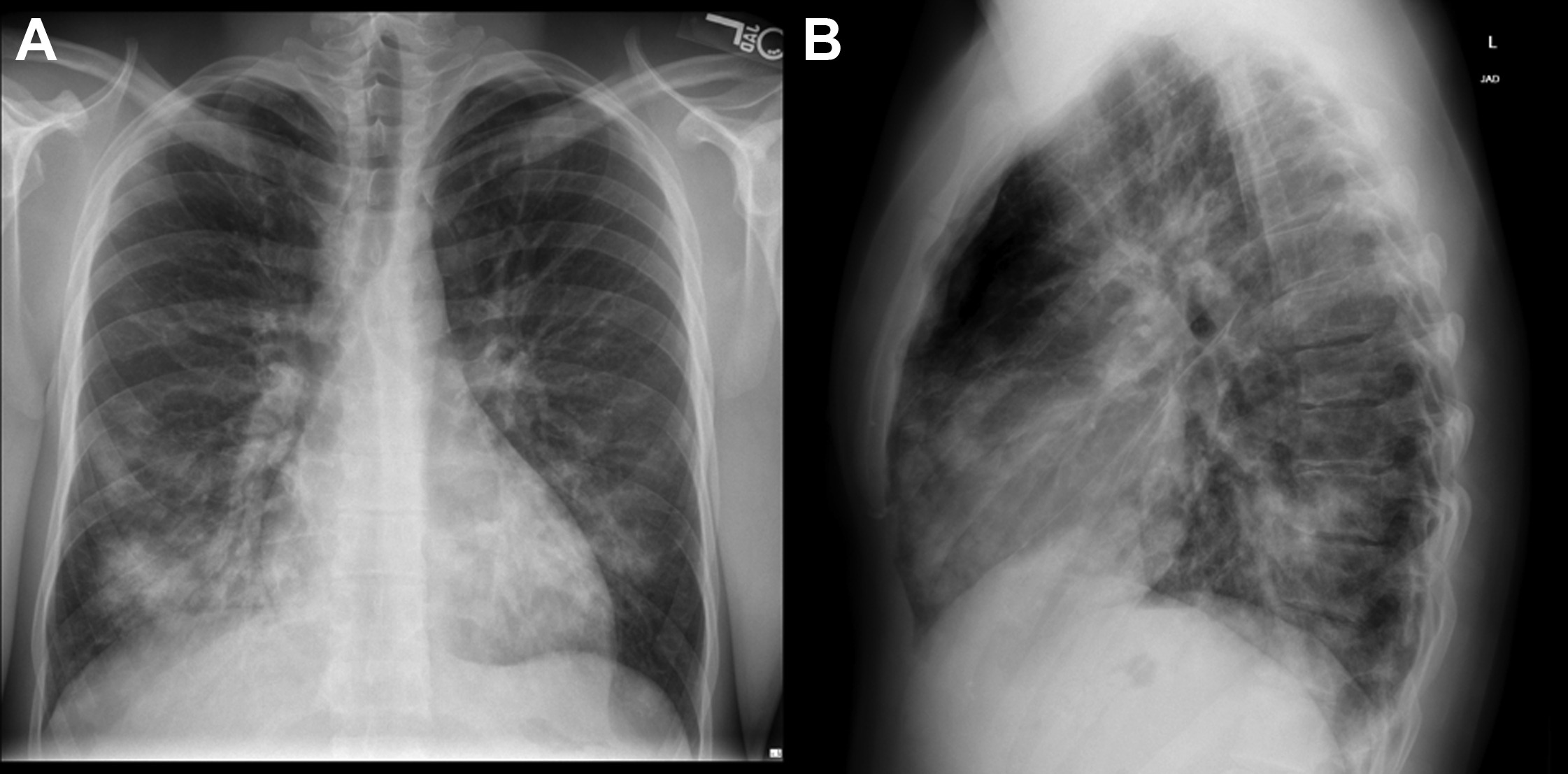 Dangers Of Diving Pulmonary Edema DesertDivers