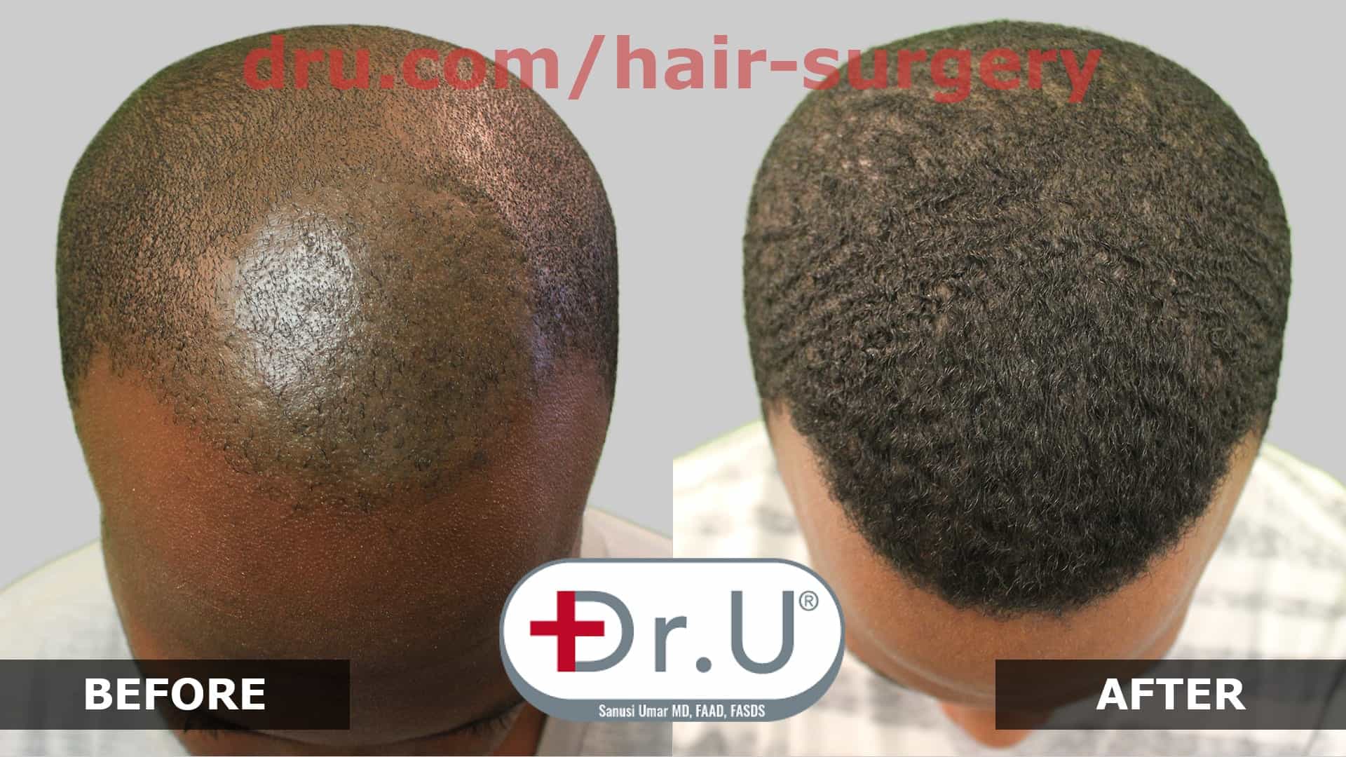 Video BEST TOOL FOR FUE Hair Transplant for Black Men