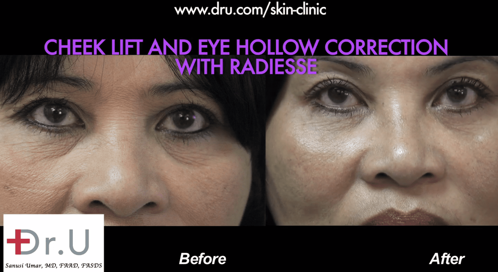 Video Cheek Lift Without Surgery and Hollow Eye Treatment by Dr. U
