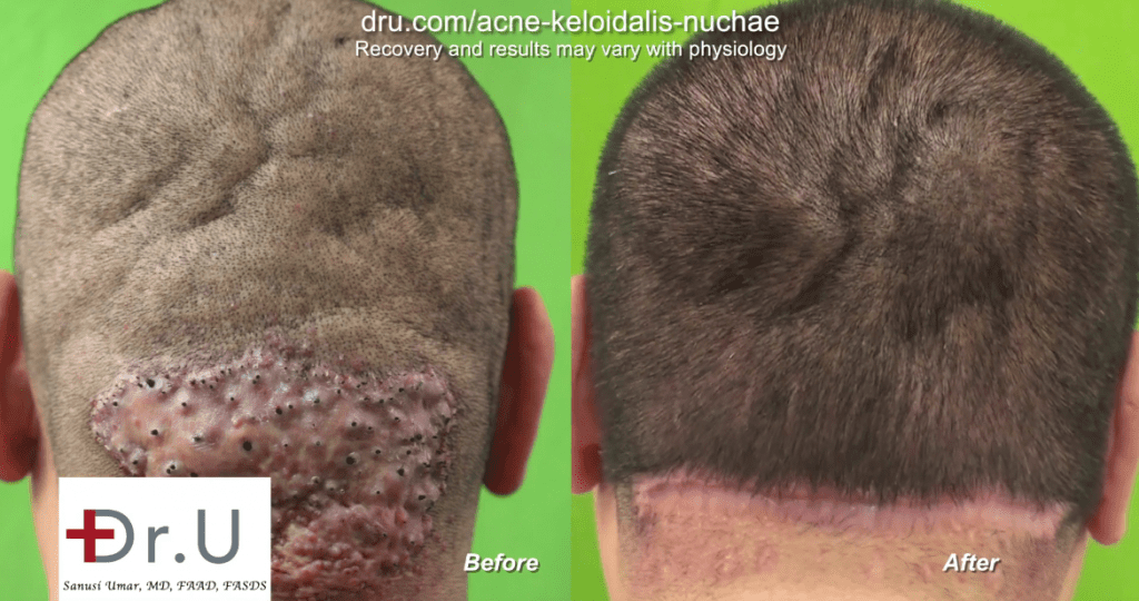 Dr U Clinic AKN Razor Bump Surgical Cure Results In Los Angeles