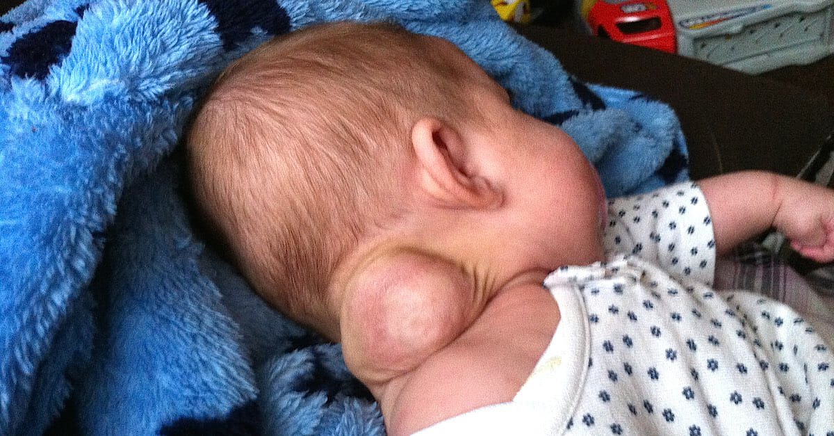 Baby born with strange lump on neck, so mom snaps photo as