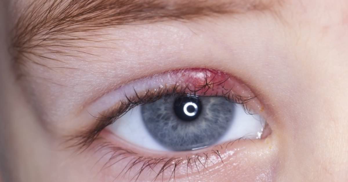 Om du vaknar och ditt öga ser ut såhär testa dessa 10 husmorstips