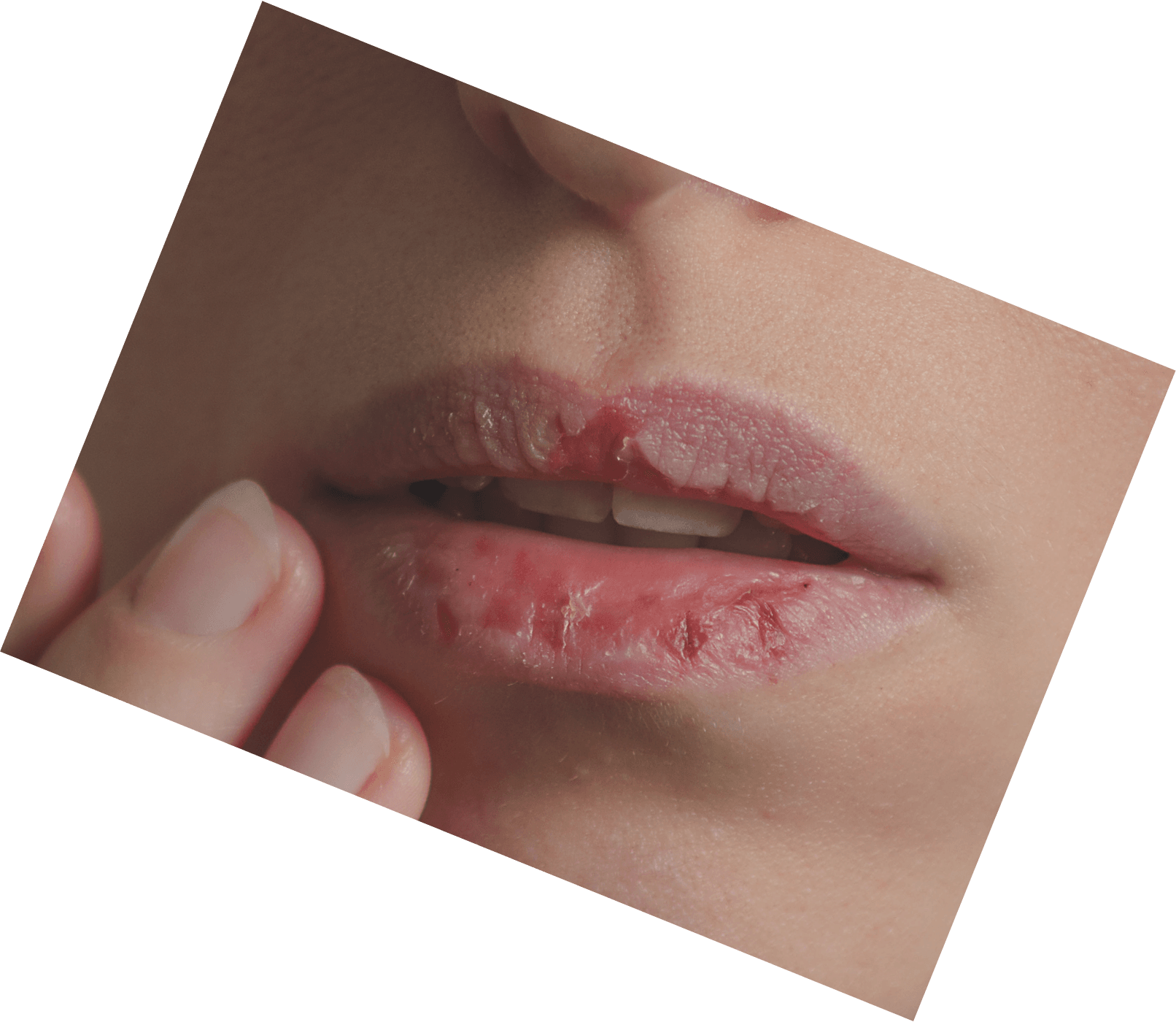 How To Get Rid Of Hot Wing Sauce Burn On Your Lips