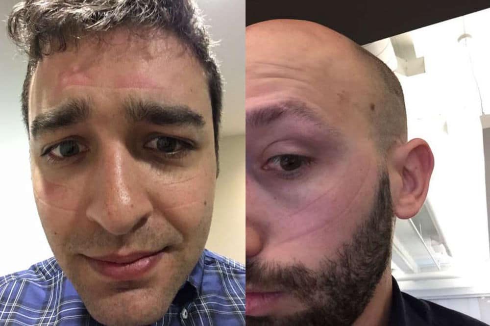 Are You Suffering From Oculus Face or Rift Rash? eTeknix