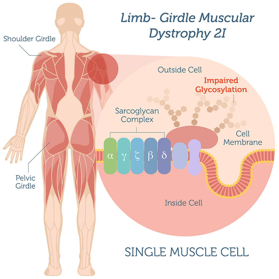 LimbGirdle Muscular Dystrophy Type 2I Genebase