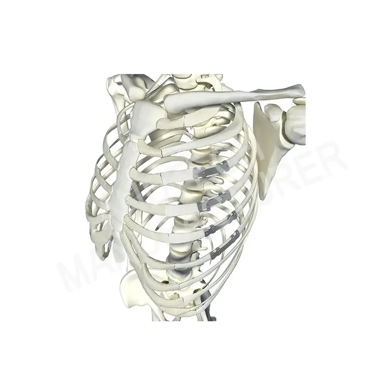 China Best Distal Fracture Quotes Surgical Rib Bone Plate with Pure