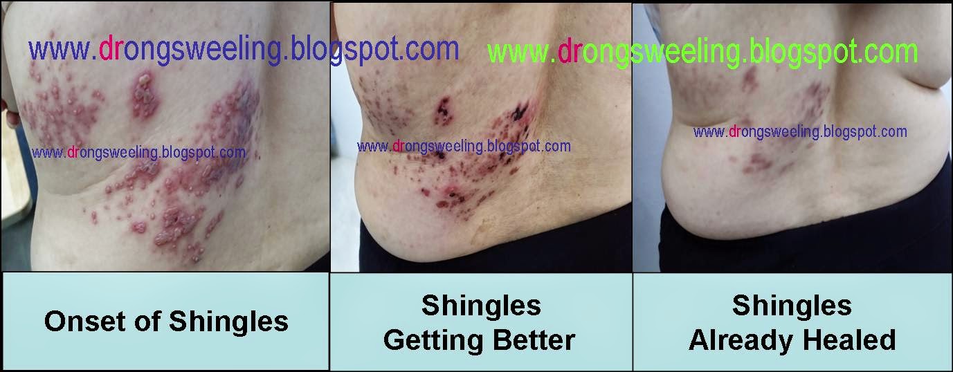 The Risks Of Deep Tissue Massage For People With Shingles Heidi Salon