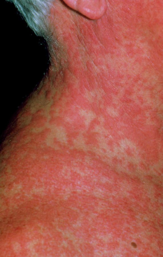 Skin Rash After Eating Acidic Foods Heidi Salon