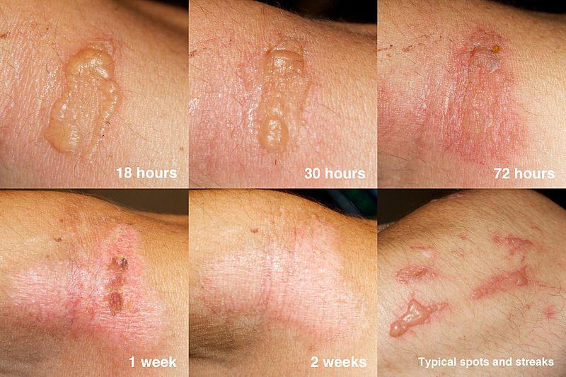 The Pros And Cons Of Using Acids To Treat Skin Rash Heidi Salon