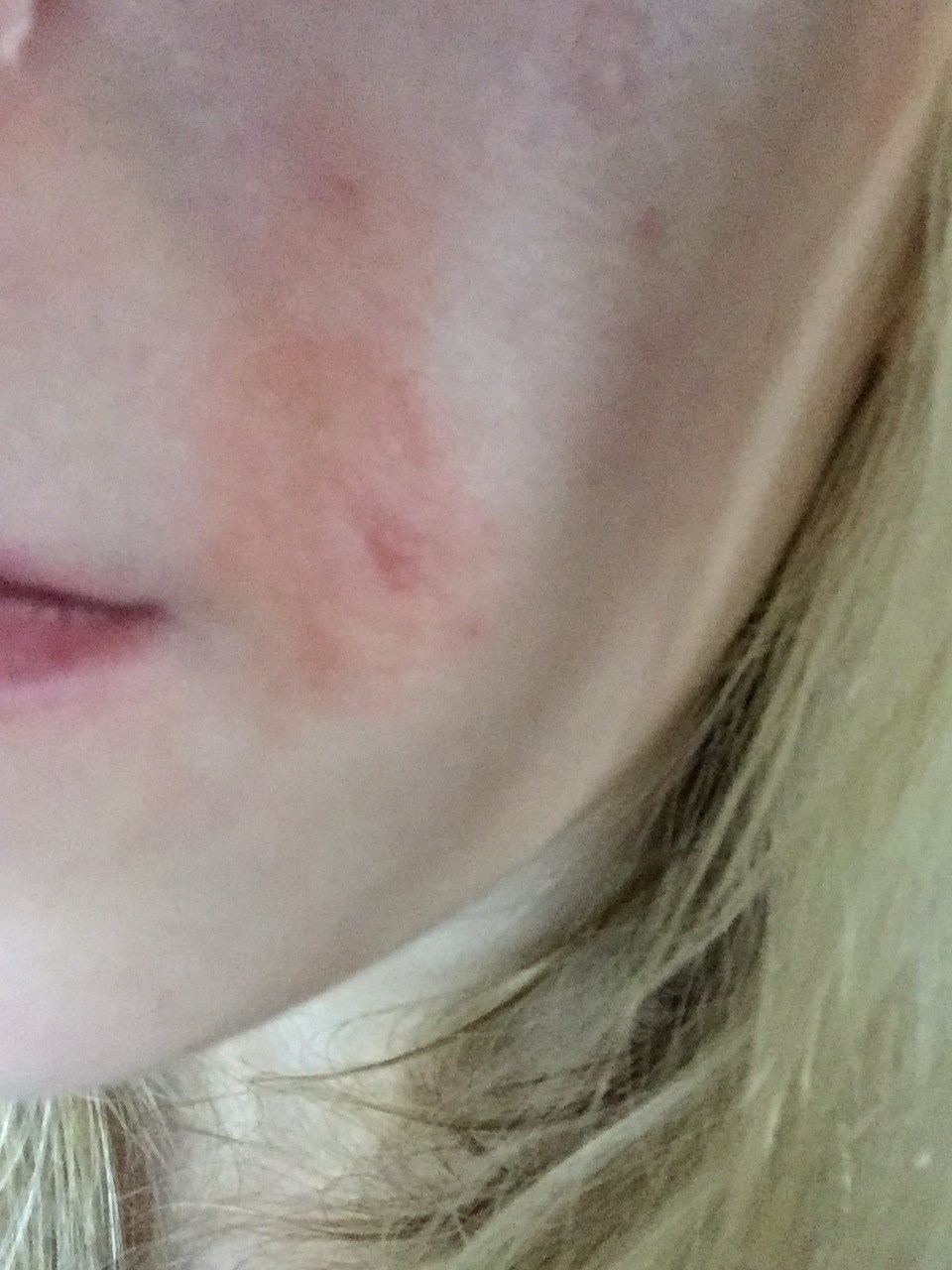 Epiduo The Topical Gel For Treating Acne Heidi Salon