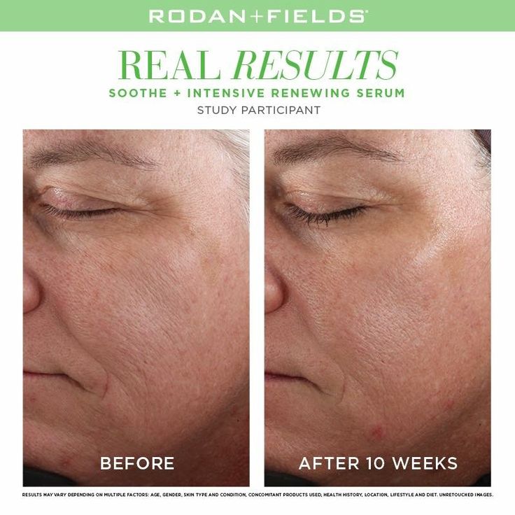 Does Epilator Remove Dead Skin Heidi Salon