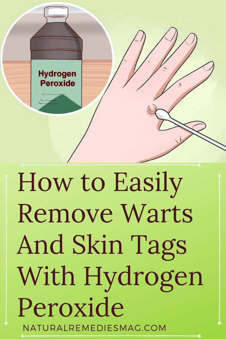 Does Hydrogen Peroxide Really Work For Dead Skin Removal? Heidi Salon