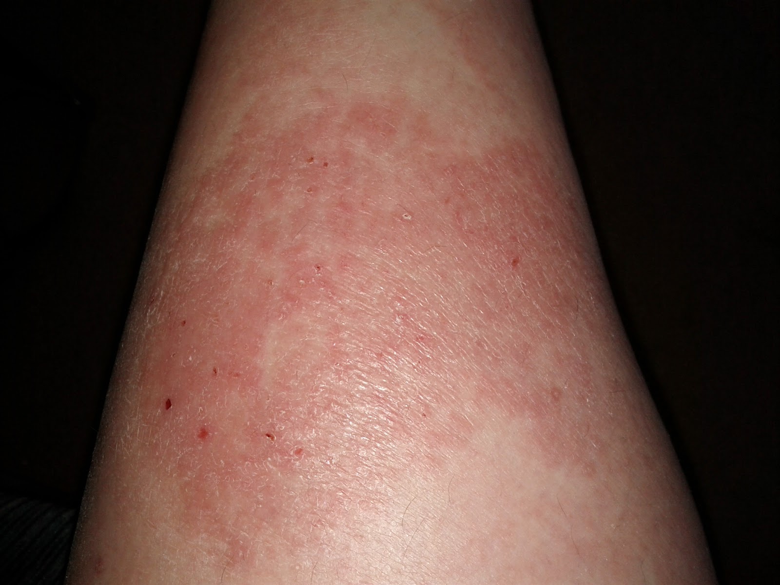 Hyperthyroidism And Skin Discoloration Heidi Salon