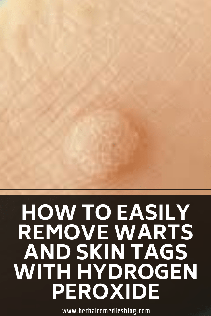 Does Hydrogen Peroxide Remove Dead Skin From Feet Heidi Salon