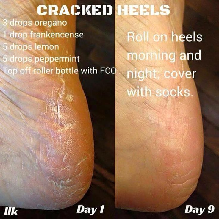 How To Get Rid Of Dead Skin On Your Feet Heidi Salon