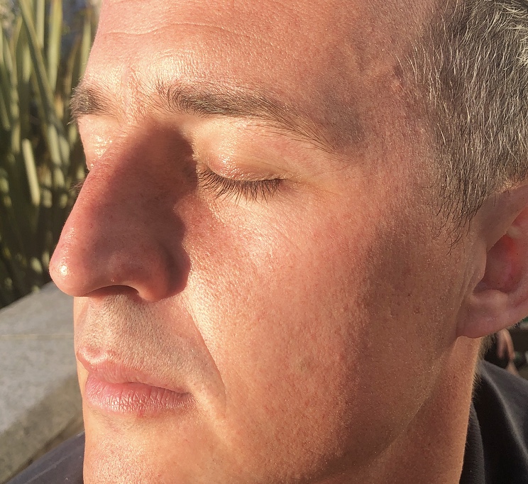 Purpura A Condition Caused By Sun Damaged Skin Heidi Salon