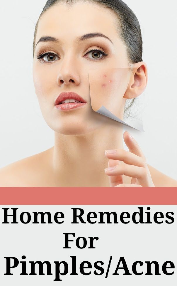 How To Remove Pimple In One Day For Oily Skin Heidi Salon