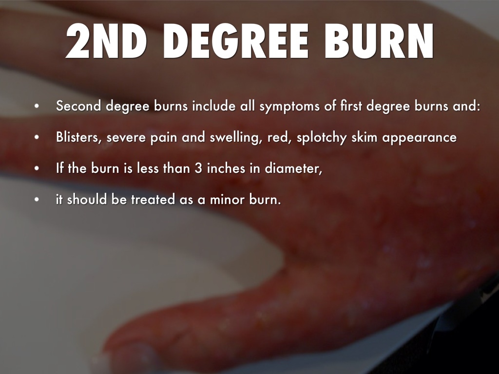 The Effects Of A Burn Heidi Salon