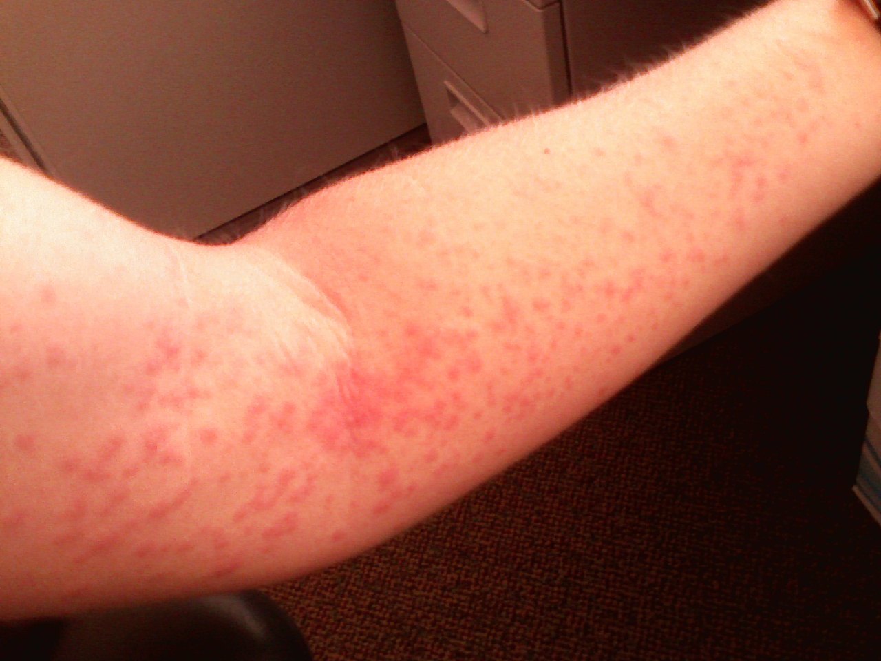 What You Need To Know About Skin Rashes From The Sun Heidi Salon