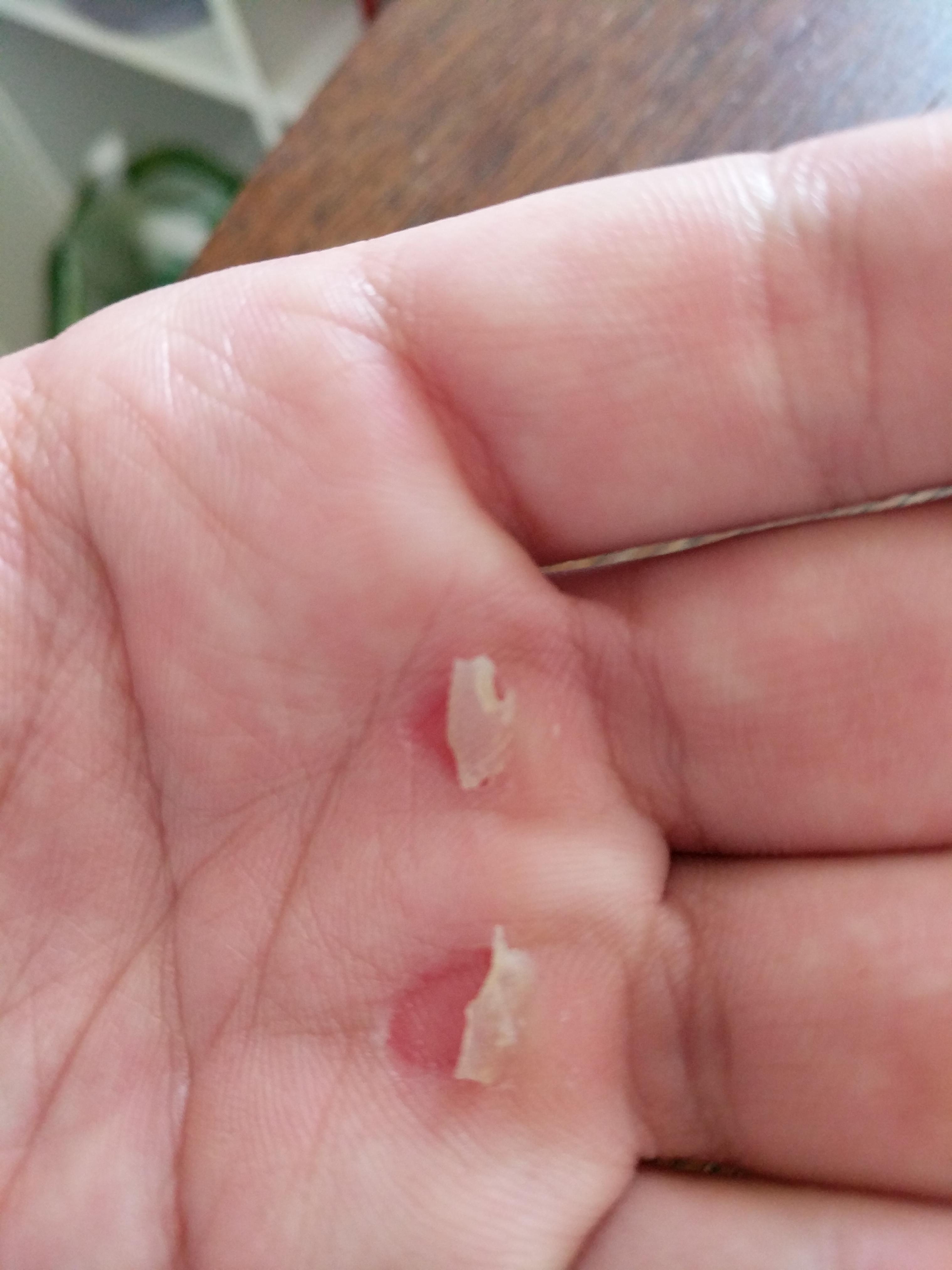 What Causes Excessive Dead Skin Heidi Salon