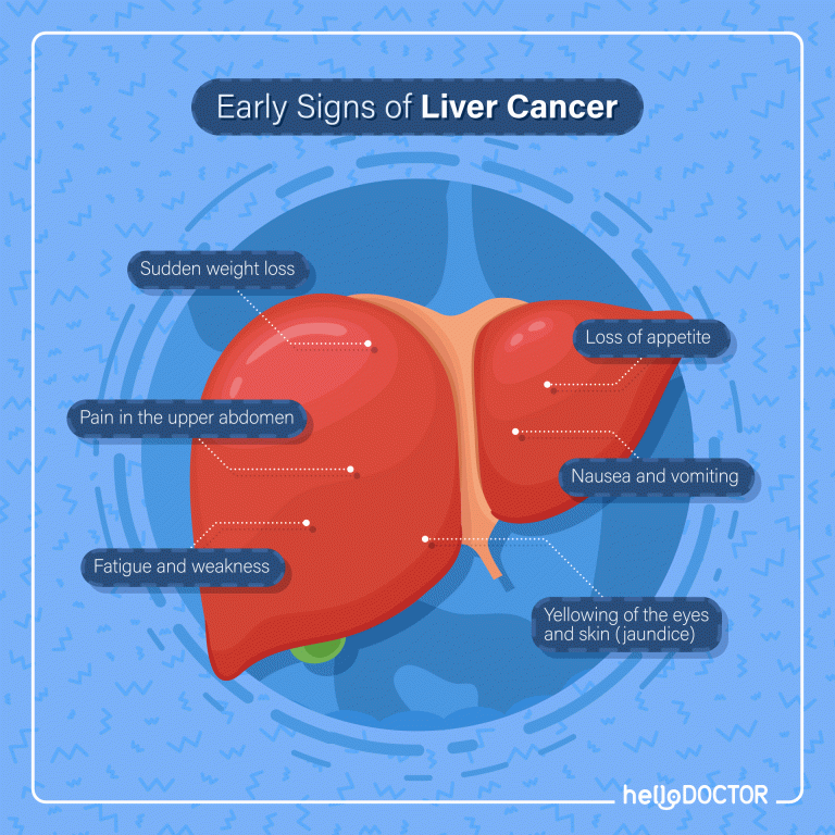 Stages of Liver Cancer What Happens In Stages 1 4?