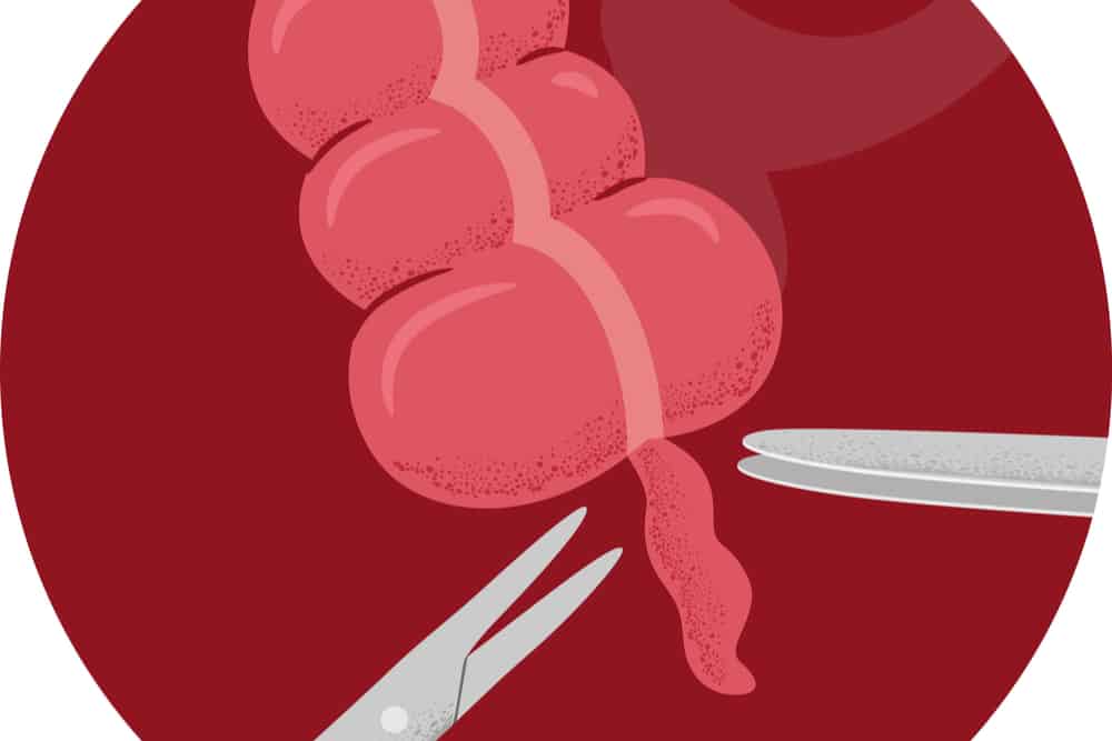 Appendectomy What is it and How is the Procedure Done?