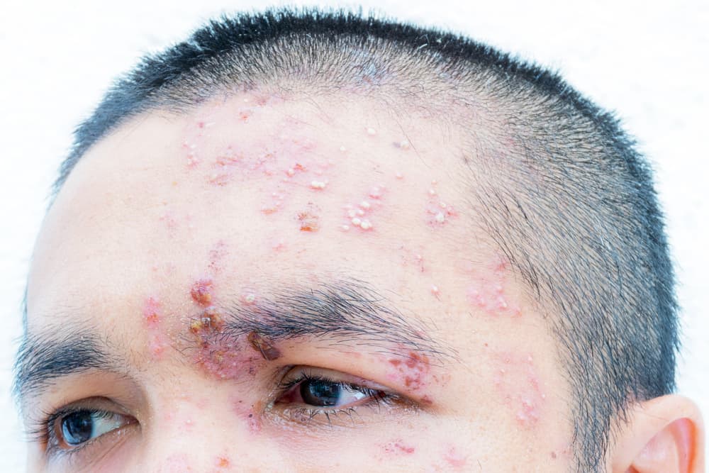 HIV Tongue and Other Telling Signs of HIV/AIDS The Symptoms to Know