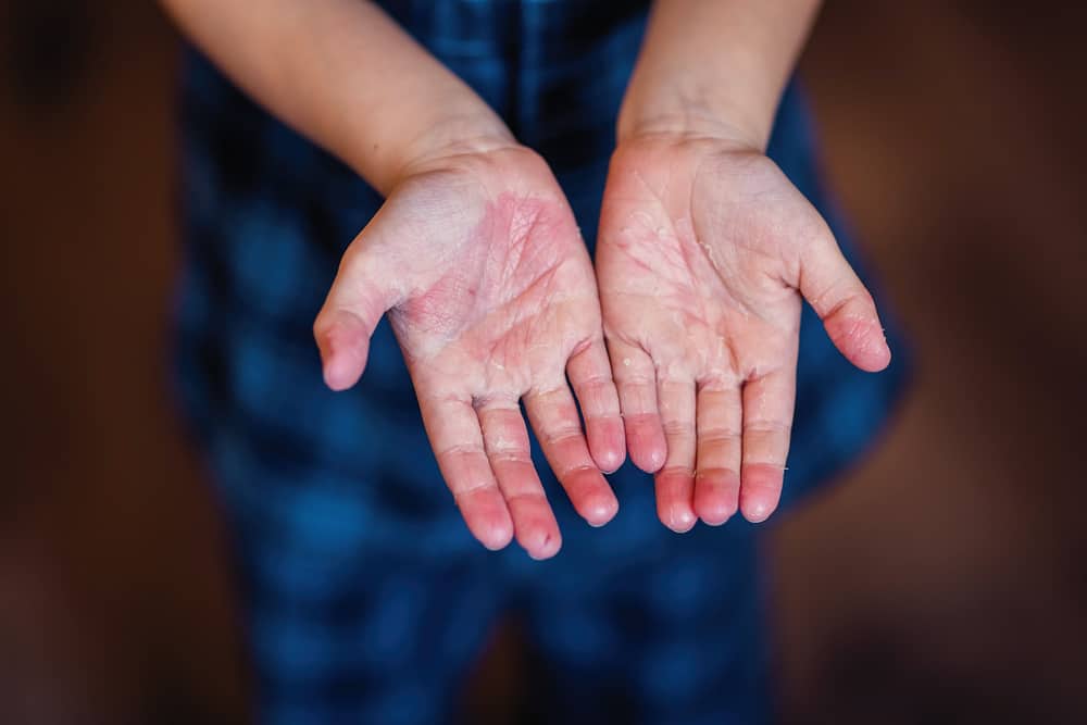 Viral Infection Rash In Children What Can Be The Causes?