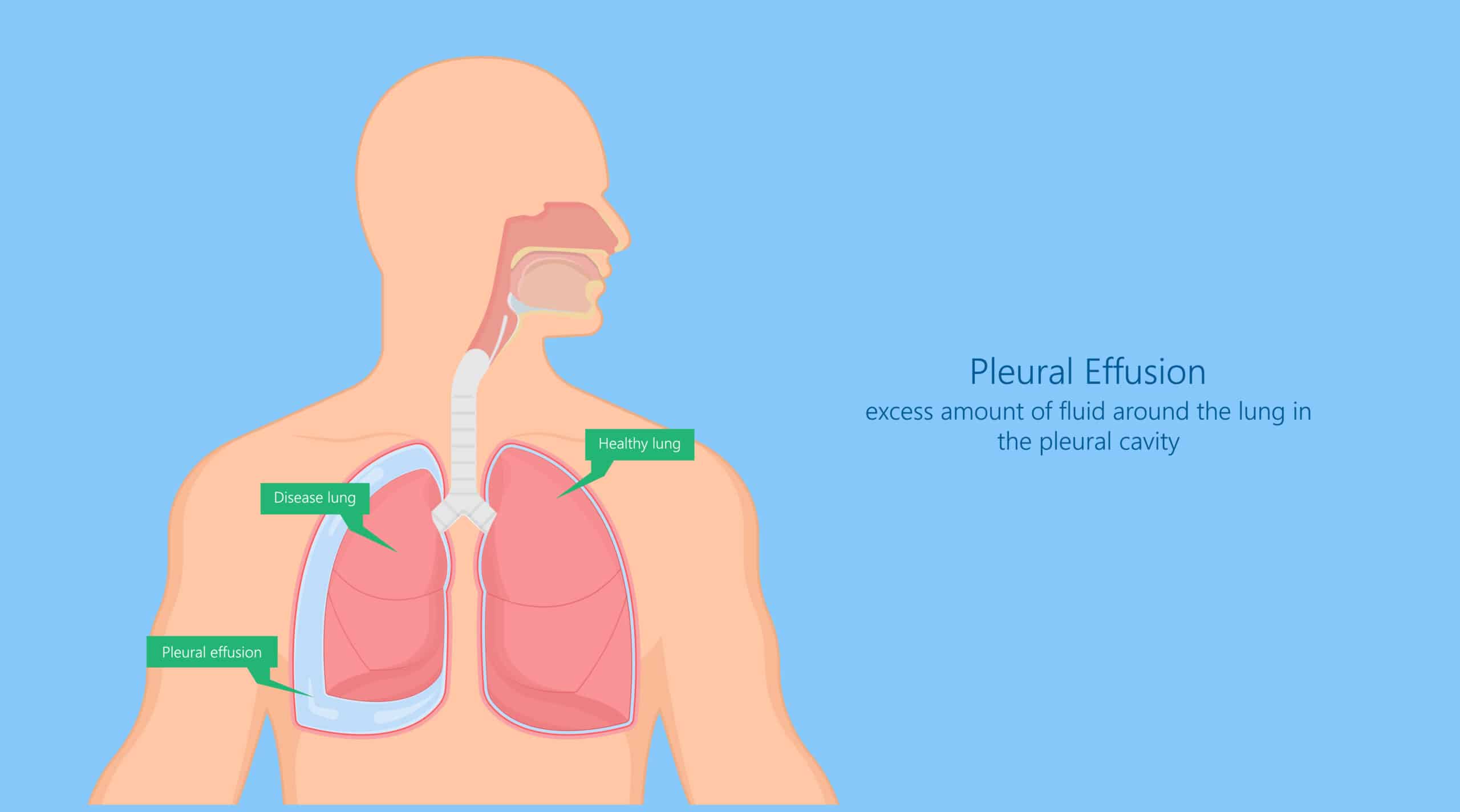 Pleural Effusion Causes, Symptoms, Treatment Hello Doctor