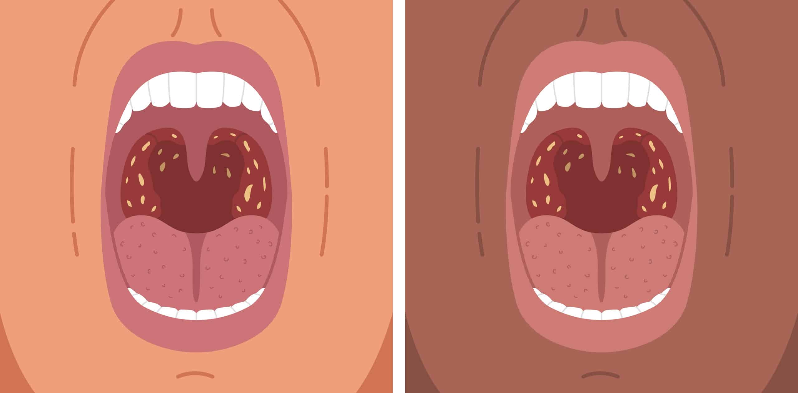 What Should You Do About Your Tonsil Stones? Find Out Here