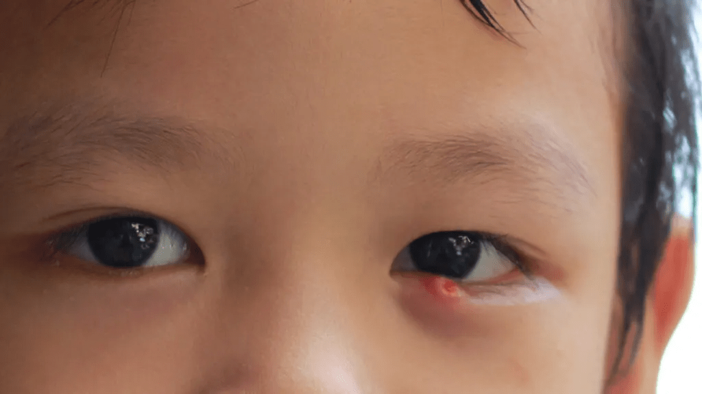 Kuliti sa Bata Alamin ang Sanhi, Sintomas, at Gamot para Dito