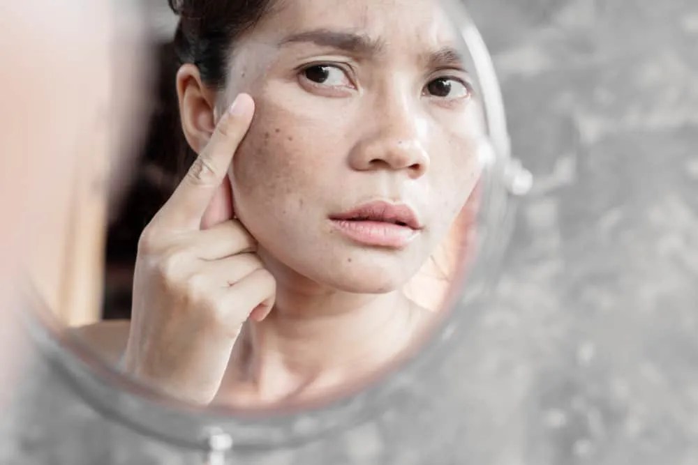 Freckles Obat Penyebab Gejala Dll Hello Sehat