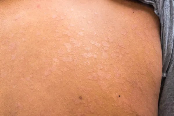 Panu (Tinea Versicolor): Gejala, Penyebab, Pengobatan, Dll.