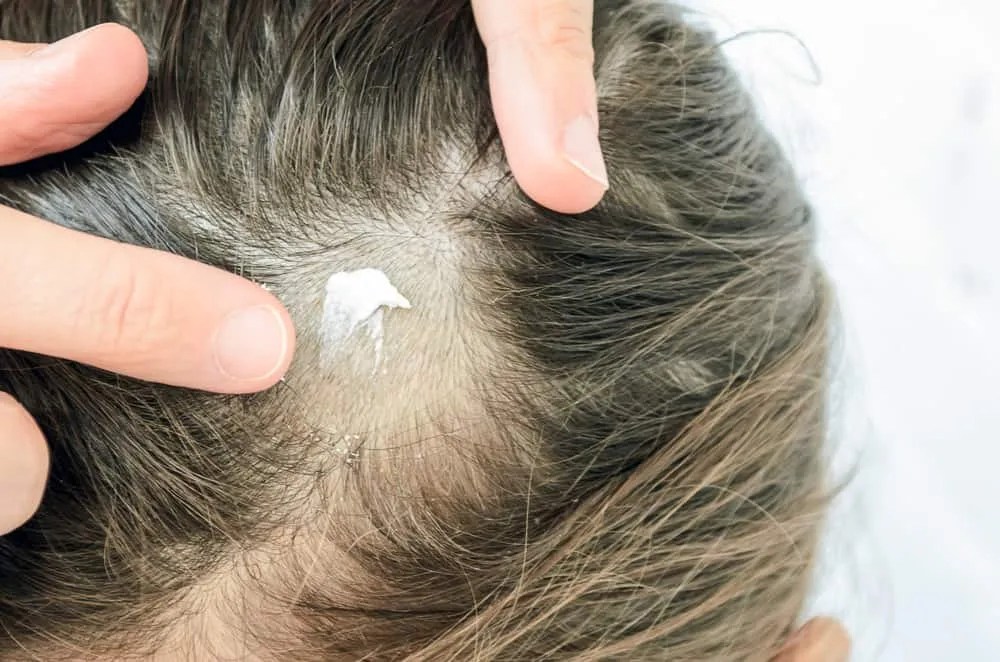 Obat Dermatitis Seboroik Yang Efektif Atasi Kulit Bersisik