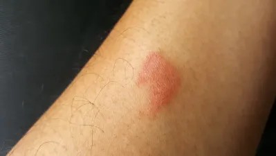 Usai Digigit Kelabang, Kenali Bahaya dan Pengobatannya | Hello Sehat