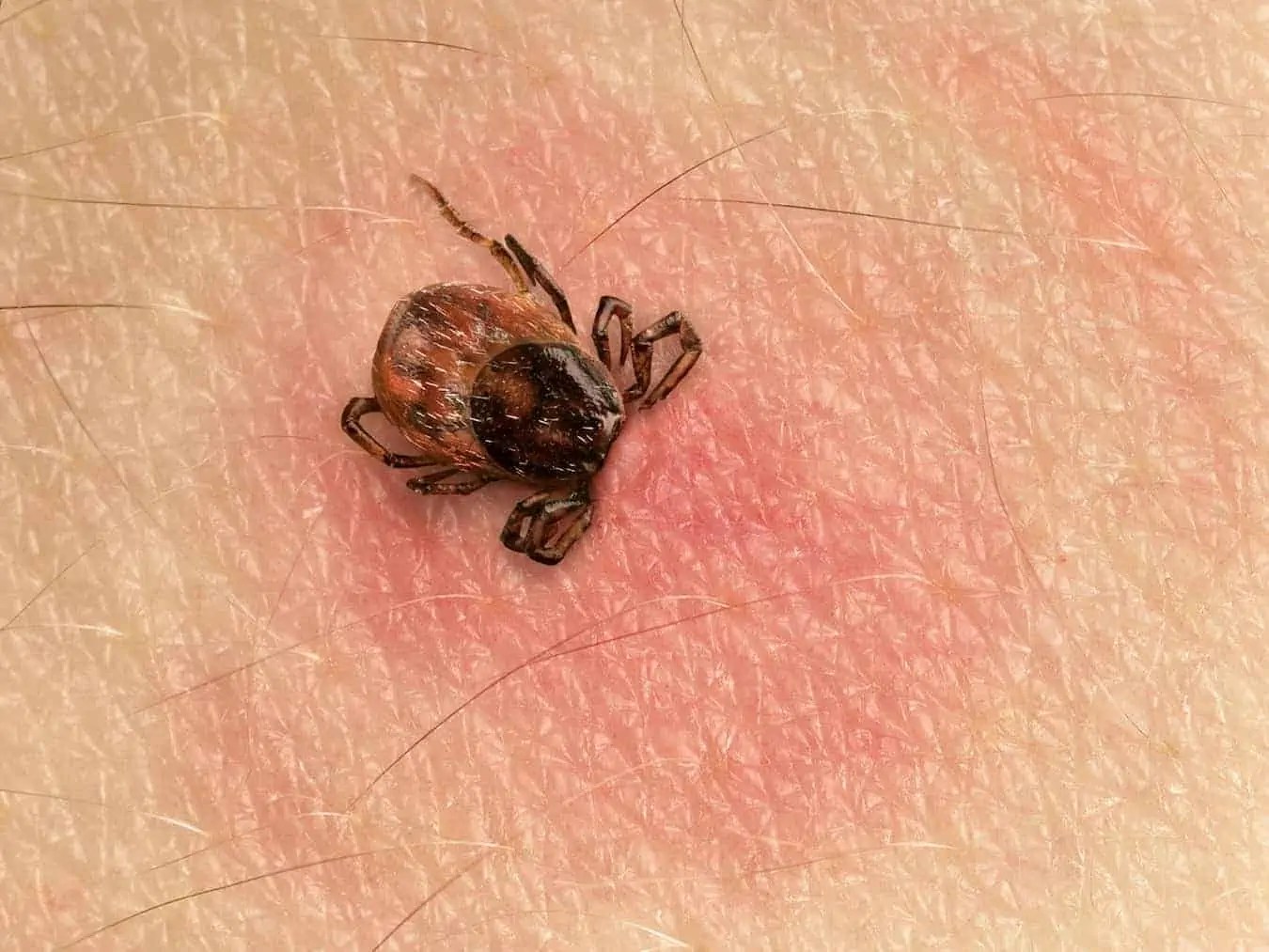 How to Identify Tick Bites Tick Bite Pictures IGeneX Tick Talk