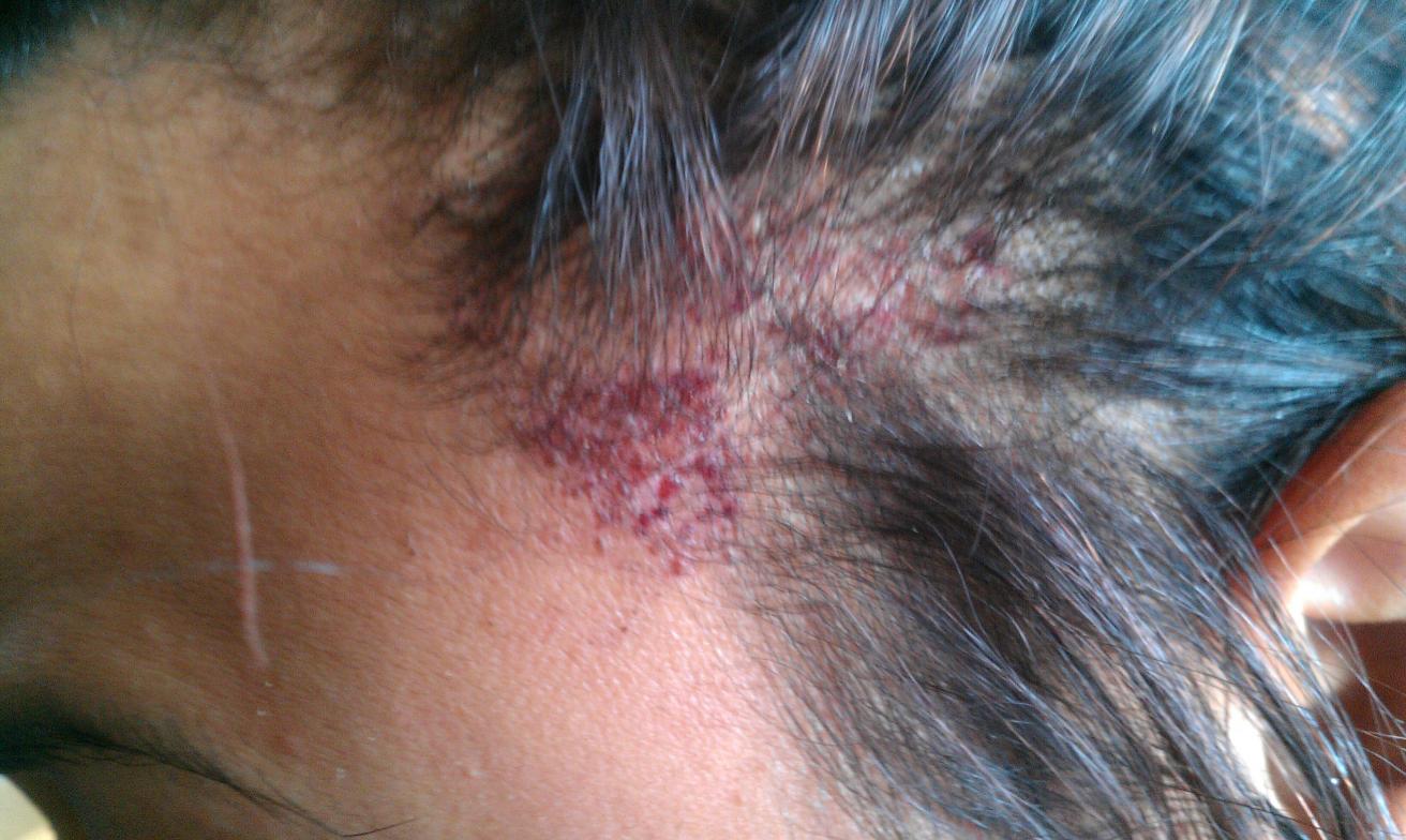 Burnt scalp from hair relaxer Salon Geek Salon Professionals Forum