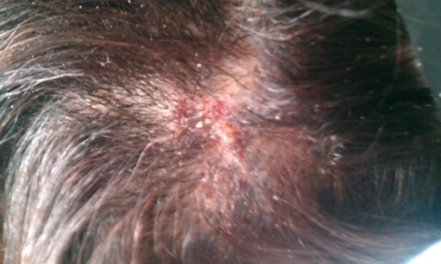 Burnt scalp from hair relaxer Salon Geek Salon Professionals Forum
