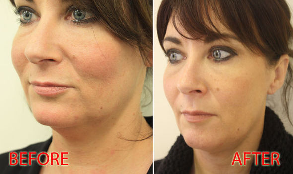 What is a thread lift? Before and after pictures show antiageing
