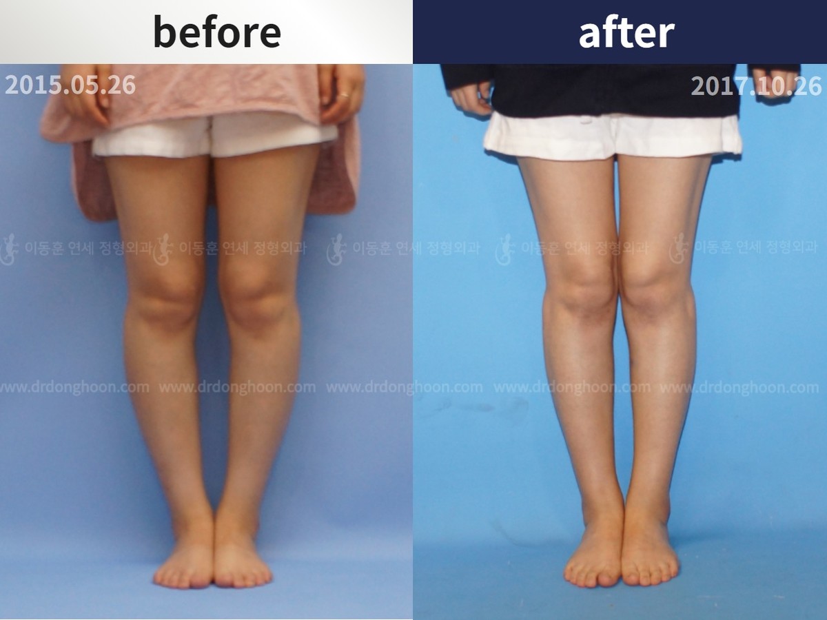 Adult Bowlegs 2mon postop Adult Bowlegs