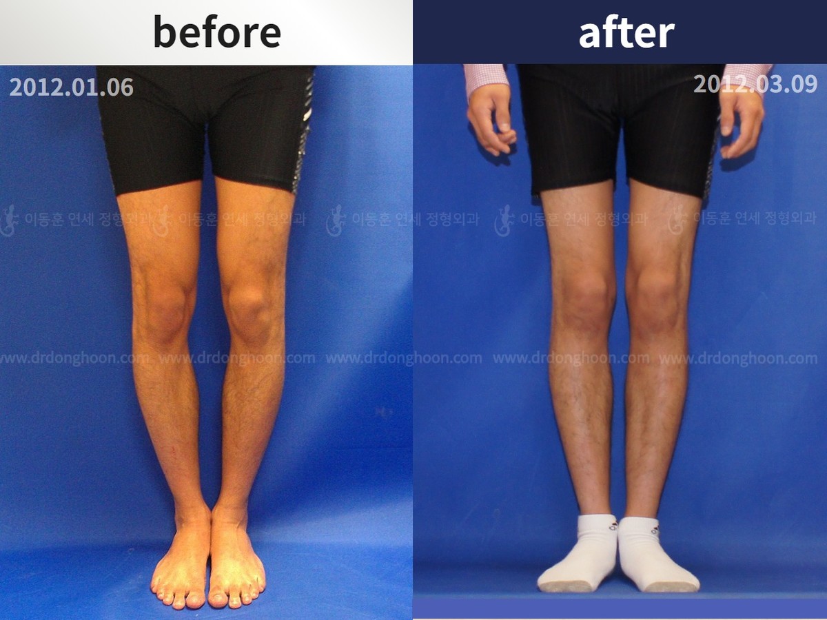 Adult Bowlegs Adult Bowlegs