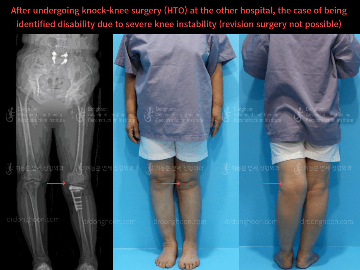 After undergoing knockknee surgery (HTO) at the other hospital, the case of being identified