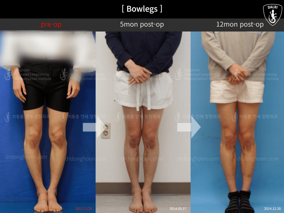 [Bowlegs] 5mon postop →12mon postop Adult Bowlegs