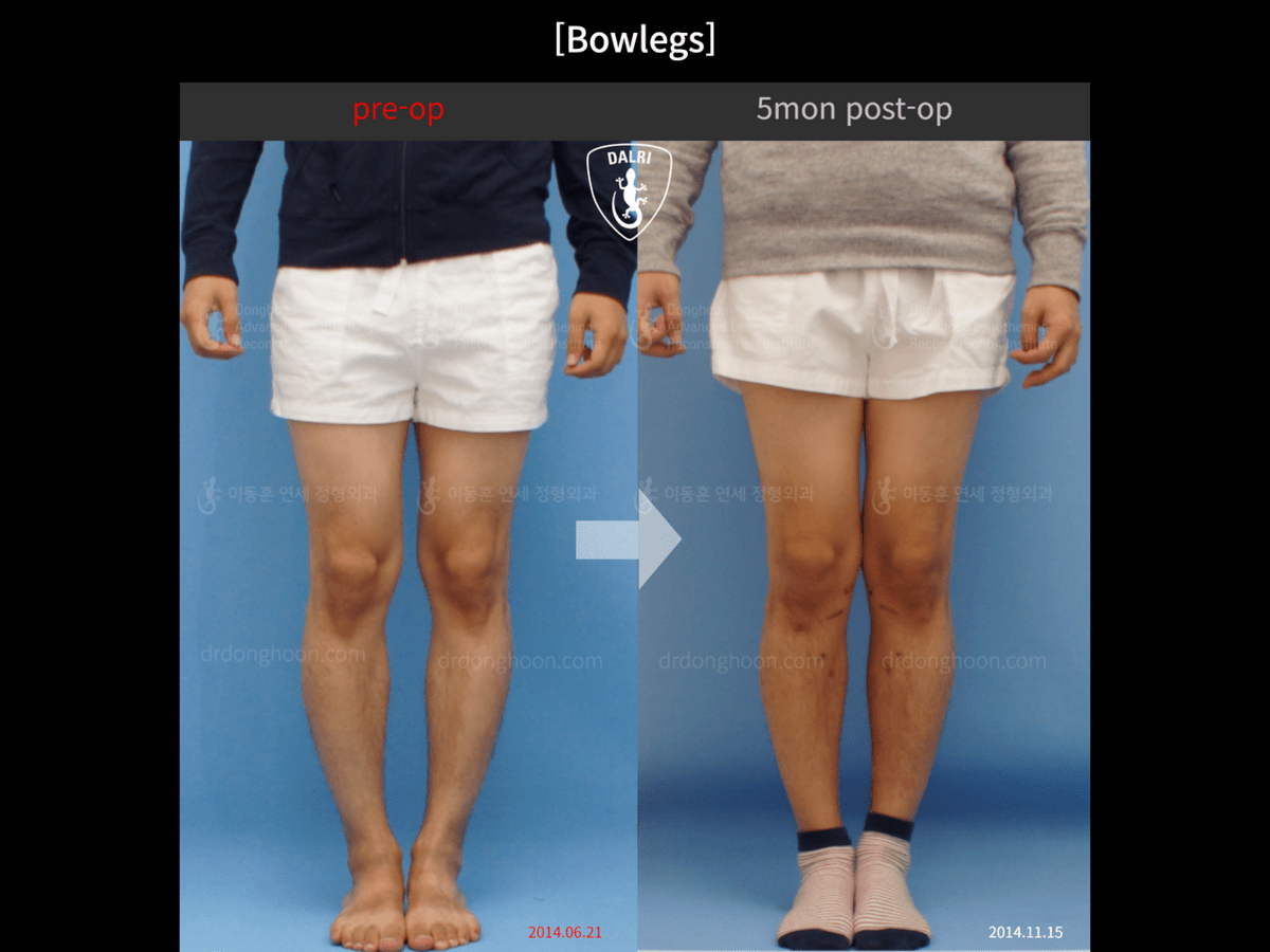 [Bowlegs] 5mon postop Adult Bowlegs