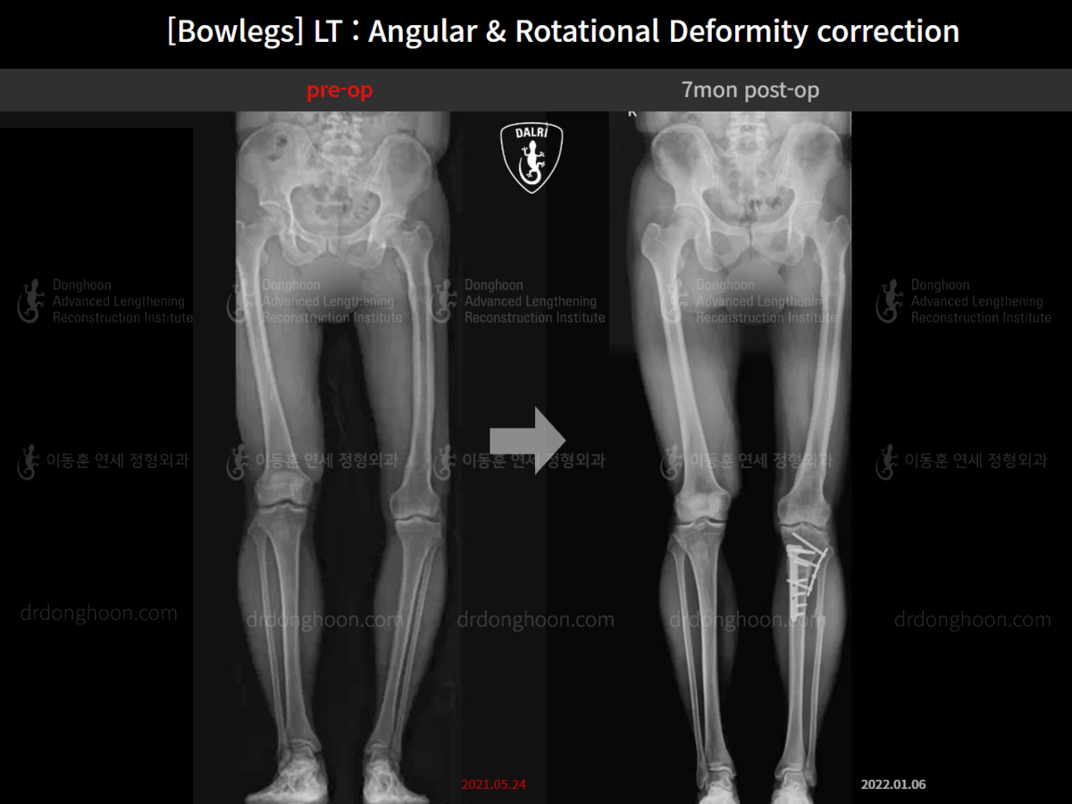 [Bowlegs] LT Angular & Rotational Deformity correction 7mon postop