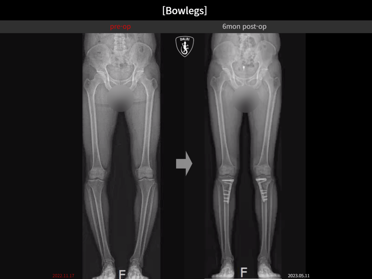 [Bowlegs] 6mon postop Adult Bowlegs