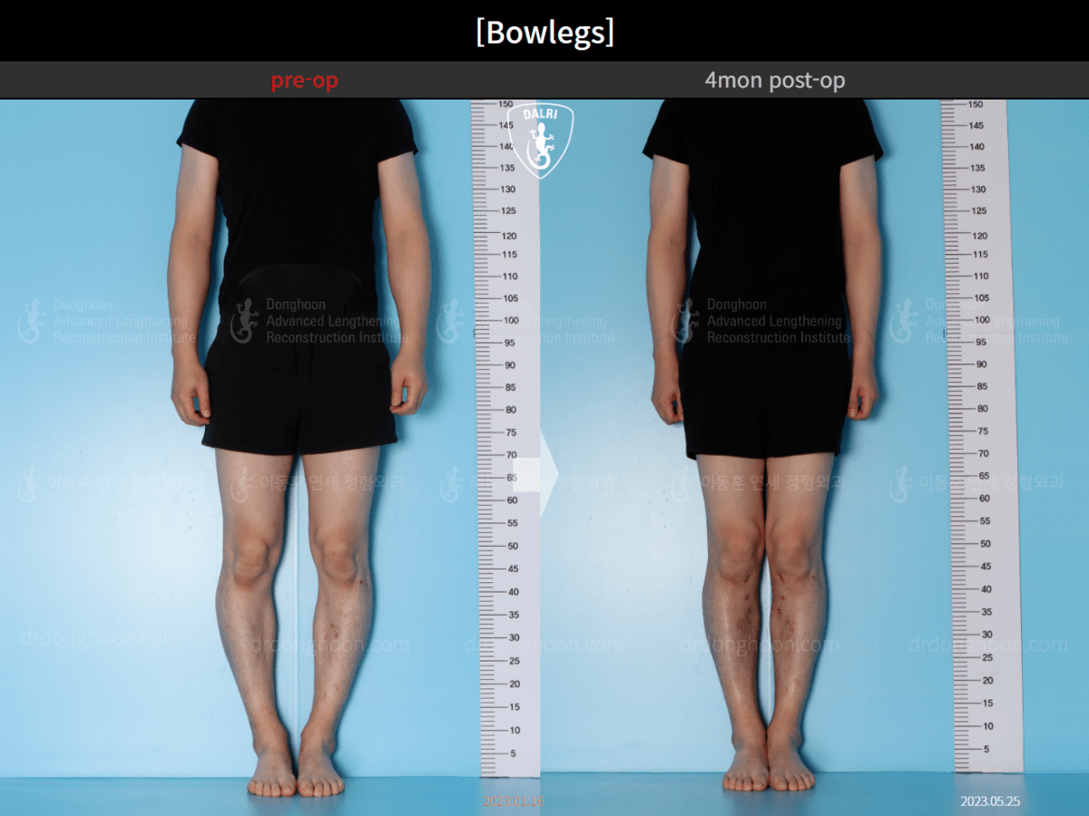 [Bowlegs] 4mon postop Adult Bowlegs