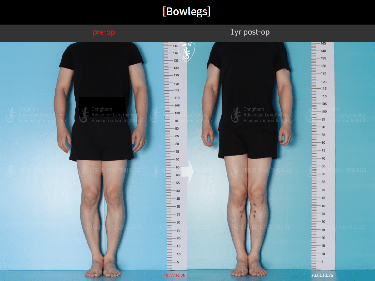 [Bowlegs] 1yr postop +Scars Adult Bowlegs