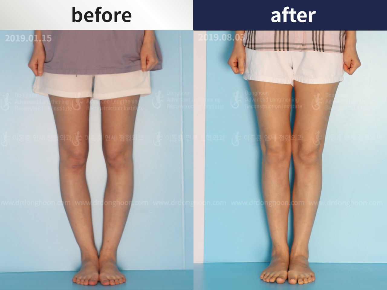 Adult Bowlegs Rotational malalignment syndrome Adult Bowlegs