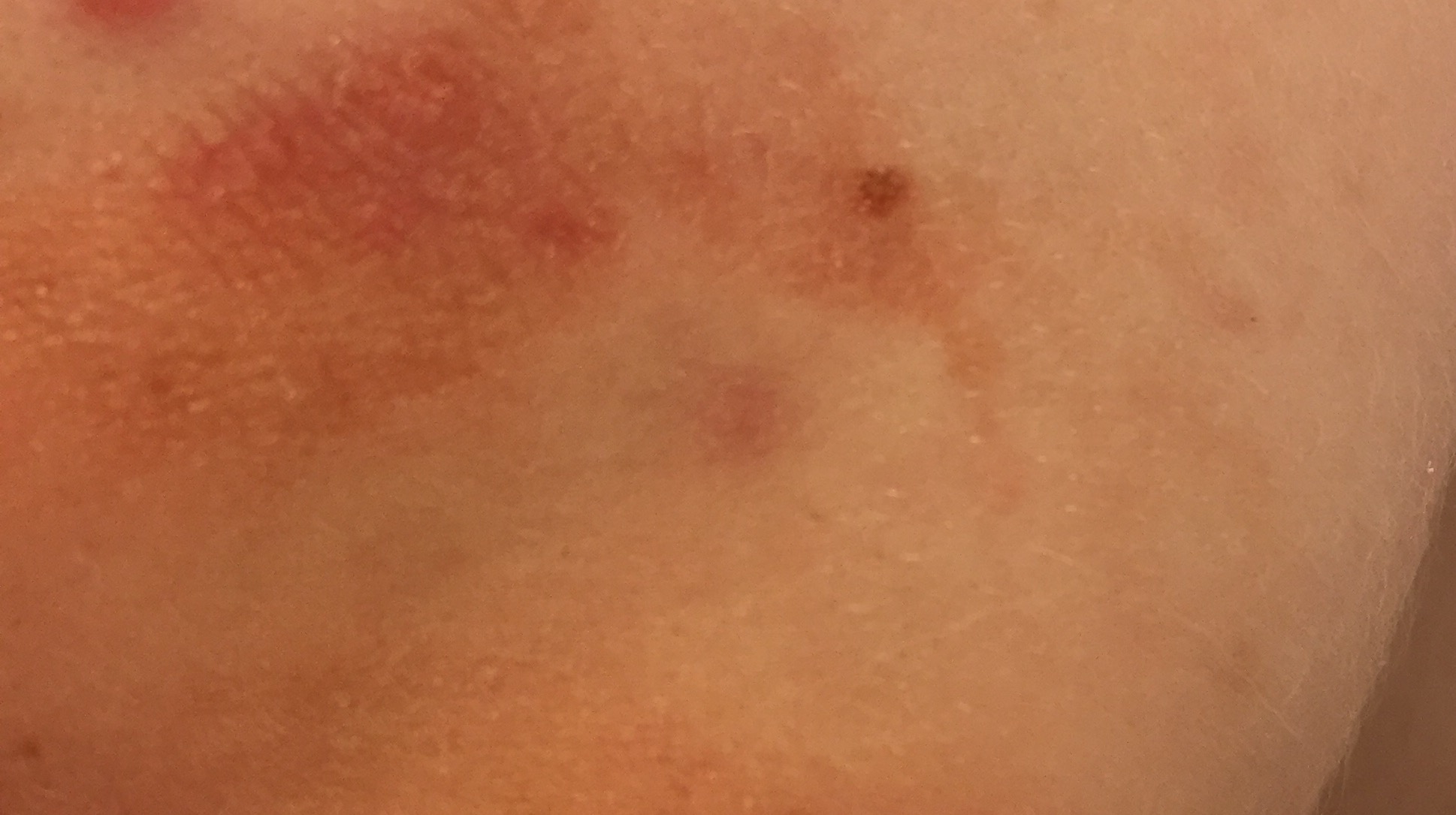 How To Use Tea Tree Oil For Acne Just Tea